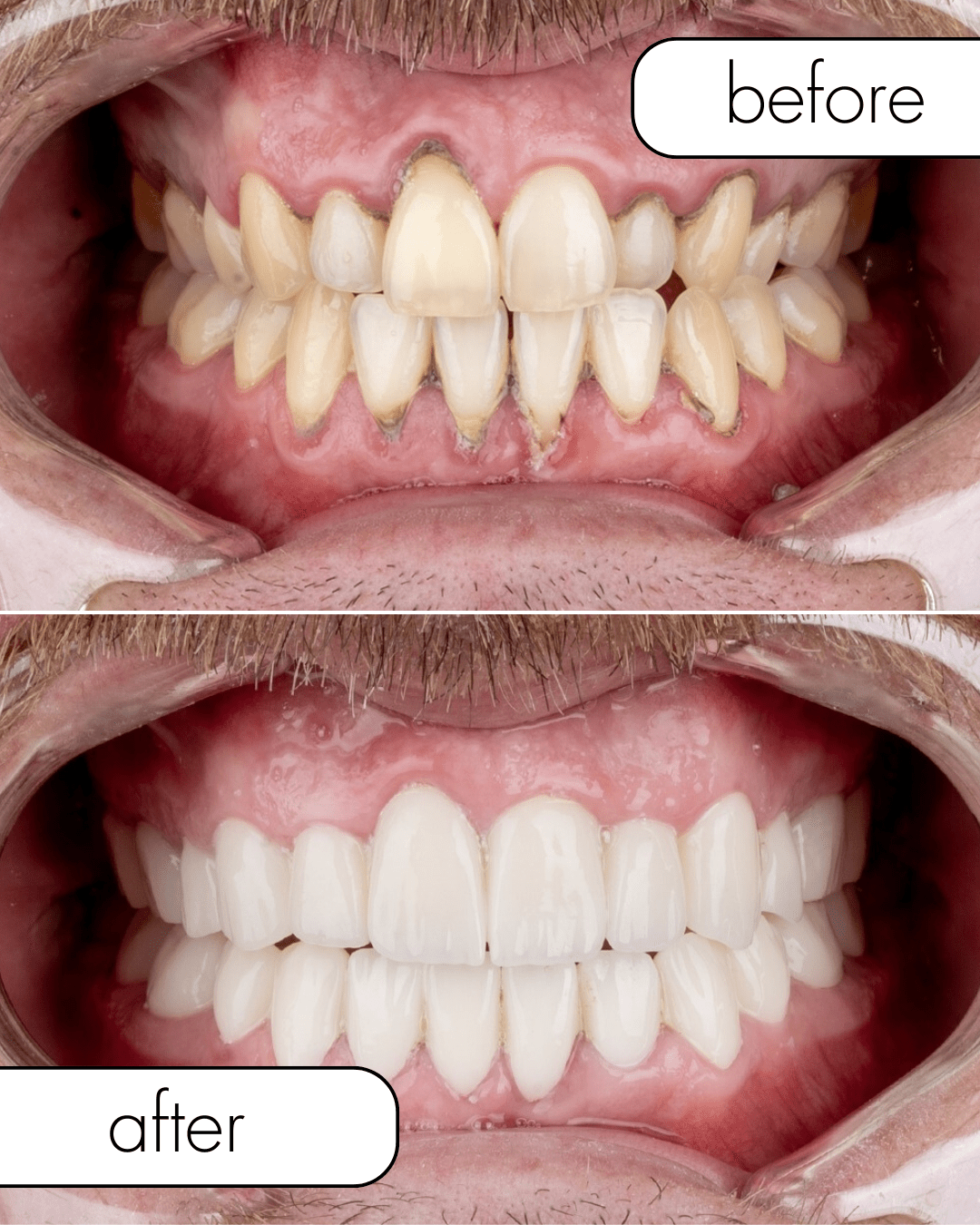 Hollywood smile