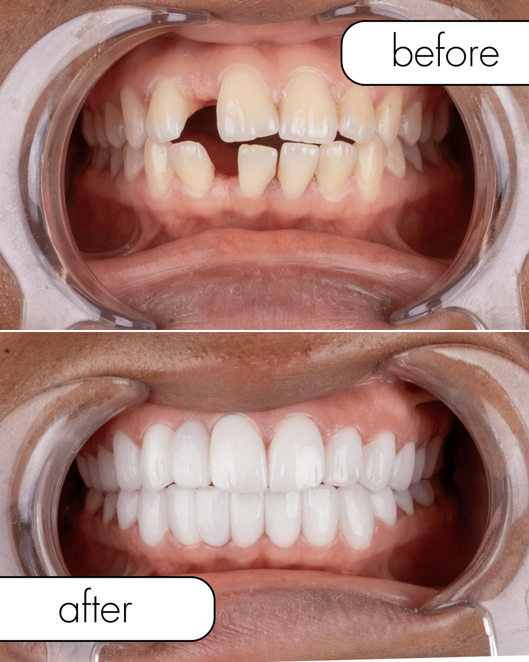 Veneer