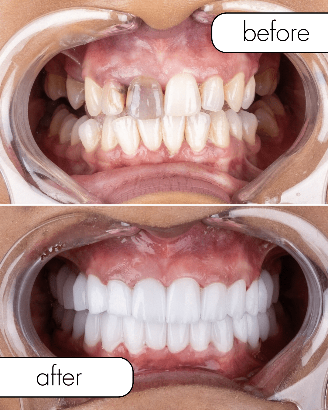 Dental Implant