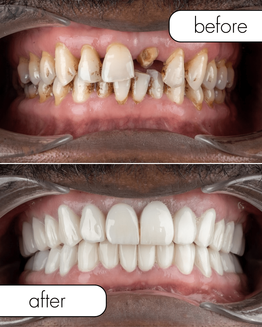 Hollywood smile