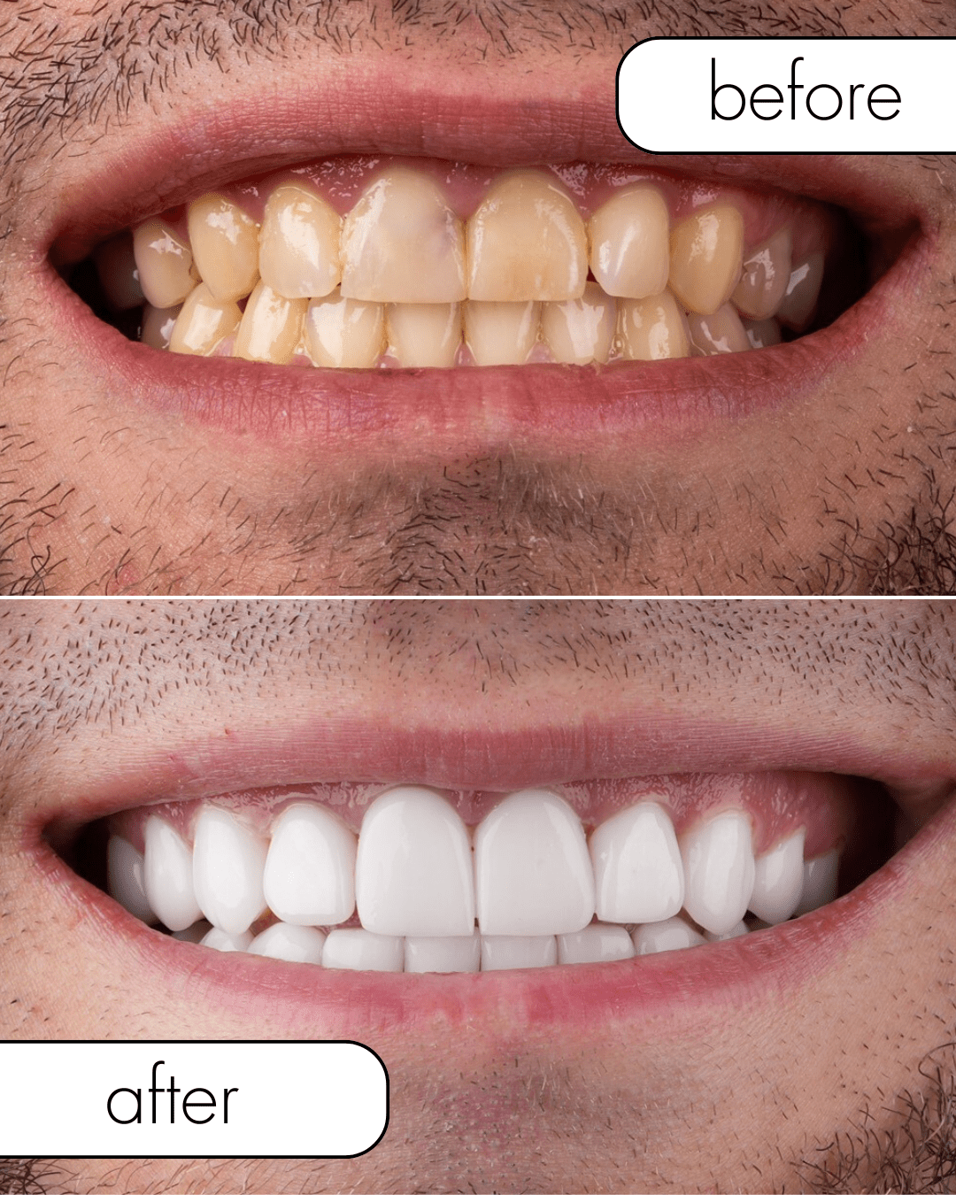 Veneer